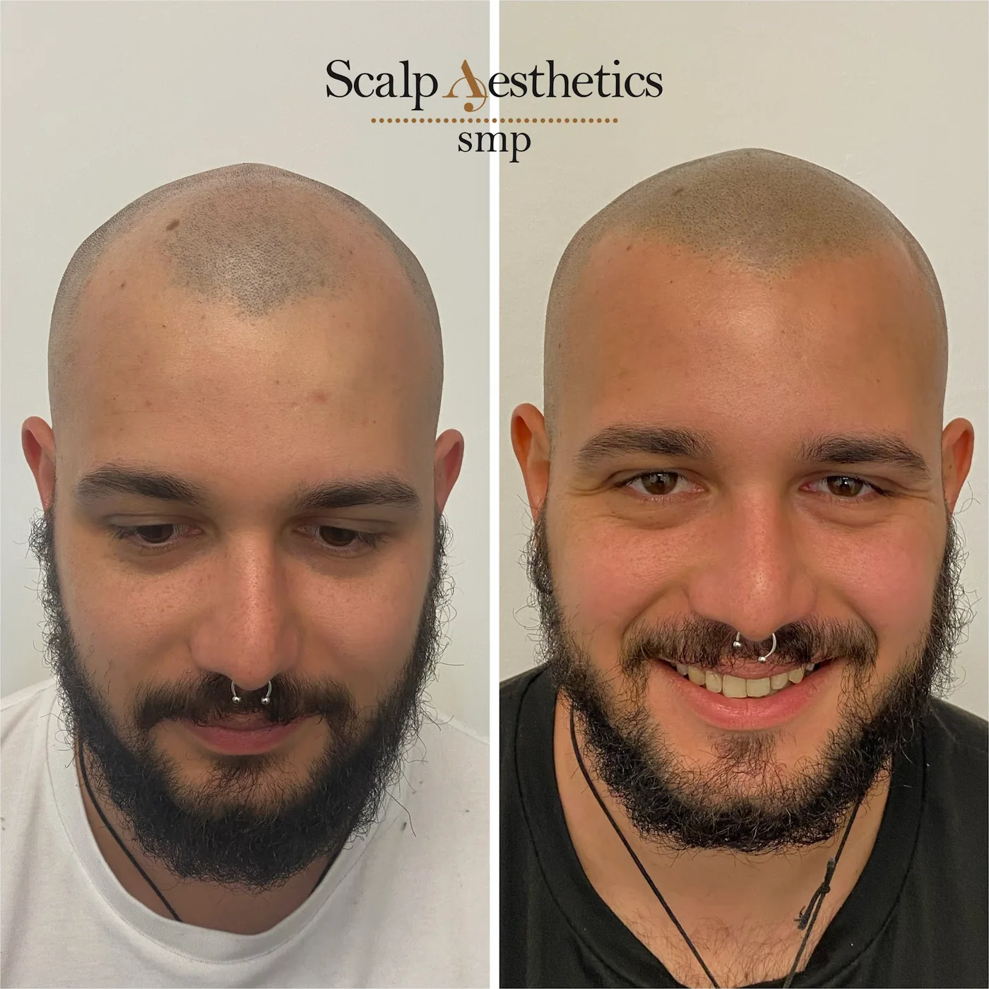 Before and after scalp micropigmentation by Lorena at the Dublin studio